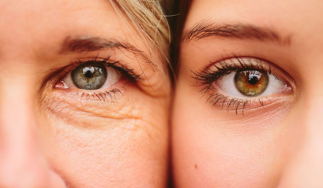आंखों के आसपास उम्र बढ़ने के लक्षण