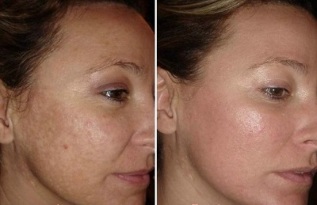 तस्वीरों के पहले और बाद में लेजर चेहरे की त्वचा कायाकल्प